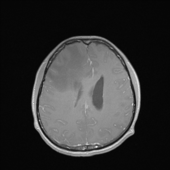 Cerebral abscess (Radiopaedia 24212-24478 Axial T1 C+ 41).jpg