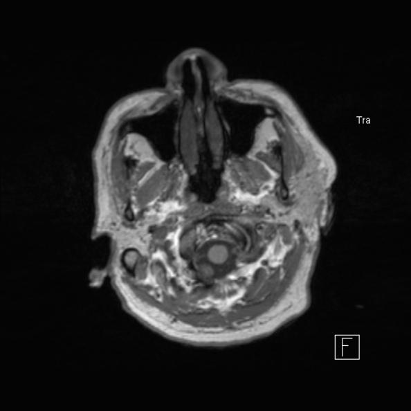 Cerebral abscess (Radiopaedia 26111-26247 Axial T1 12).jpg