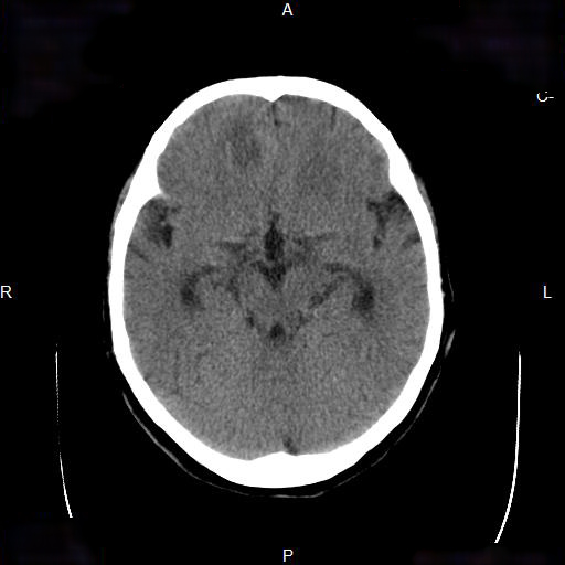 File:Cerebral abscess (Radiopaedia 7606-8431 Axial non-contrast 12).jpg