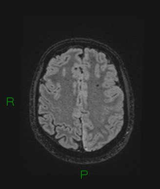 Cerebral abscess and subdural empyema (Radiopaedia 84436-99779 Axial FLAIR 27).jpg