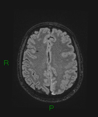 Cerebral abscess and subdural empyema (Radiopaedia 84436-99779 Axial FLAIR 30).jpg
