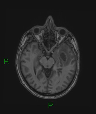 Cerebral abscess and subdural empyema (Radiopaedia 84436-99779 Axial T1 51).jpg