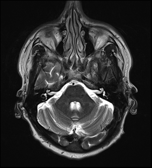 File:Cerebral abscess with ventriculitis (Radiopaedia 78965-91878 Axial T2 12).jpg