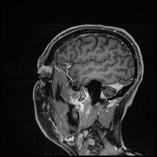 Cerebral abscess with ventriculitis (Radiopaedia 78965-91878 Sagittal T1 C+ 146).jpg