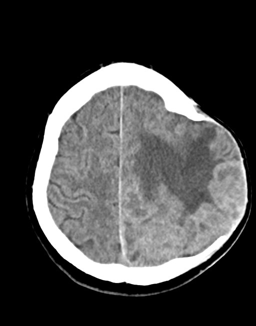 Cerebral abscesses (Radiopaedia 70458-80568 Axial non-contrast 48).jpg