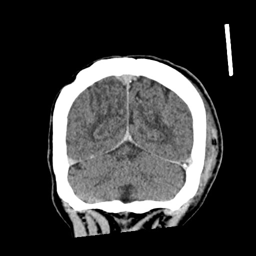 Cerebral amyloid angiopathy-related inflammation (Radiopaedia 74836-85848 Coronal non-contrast 58).jpg
