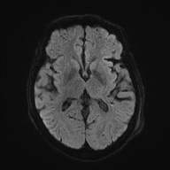 Cerebral amyloid angiopathy-related inflammation (Radiopaedia 74836-85849 Axial DWI 46).jpg