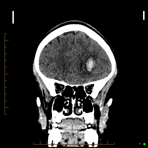 Cerebral arteriovenous malformation (AVM) (Radiopaedia 78162-90706 Coronal non-contrast 30).jpg