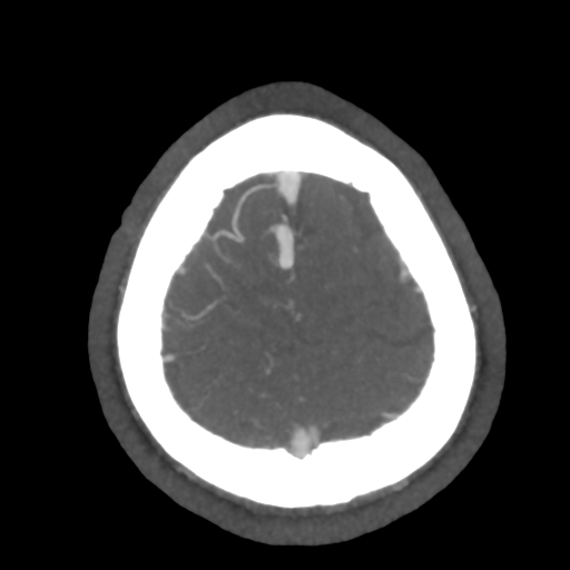 File:Cerebral arteriovenous malformation (Radiopaedia 39259-41505 AX CEREBRAL CTA 51).png