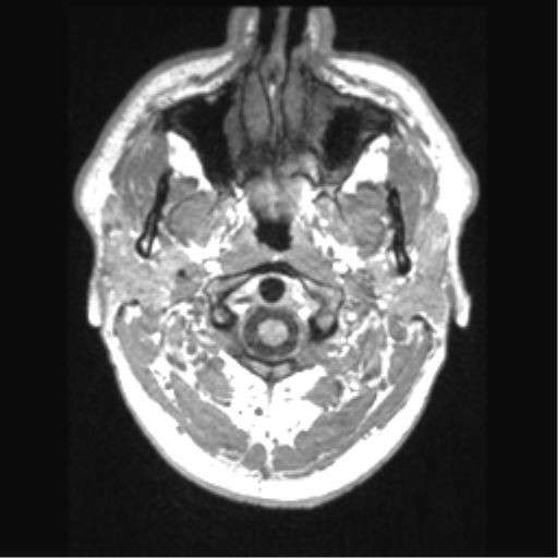 Cerebral arteriovenous malformation (Radiopaedia 39259-41506 Axial T1 3).png