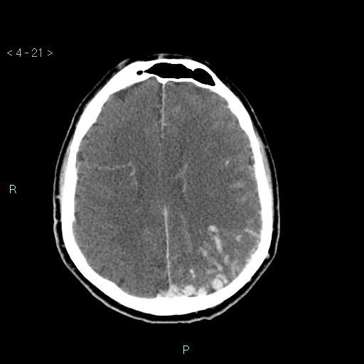 File:Cerebral arteriovenous malformation (Radiopaedia 40528-43125 Axial C+ delayed 21).jpg