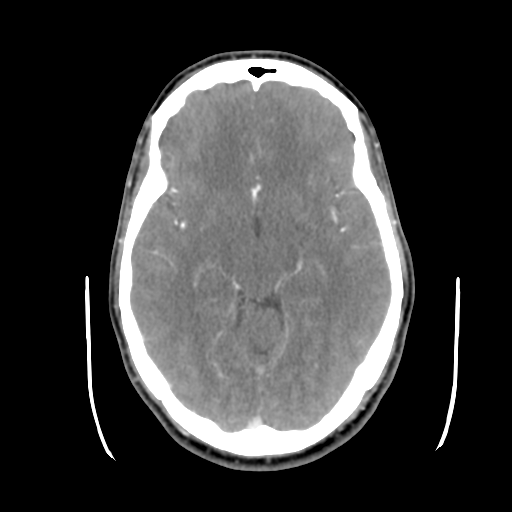 Cerebral arteriovenous malformation (Radiopaedia 55798-62371 B 22).png
