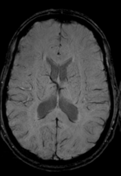 File:Cerebral arteriovenous malformation (Radiopaedia 55798-62372 Axial SWI 23).png