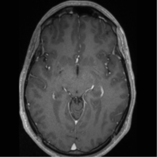 Cerebral arteriovenous malformation (Radiopaedia 55798-62372 Axial T1 C+ 33).png