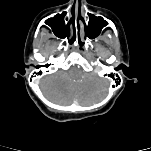 Cerebral arteriovenous malformation (Radiopaedia 73830-84645 B 82).jpg