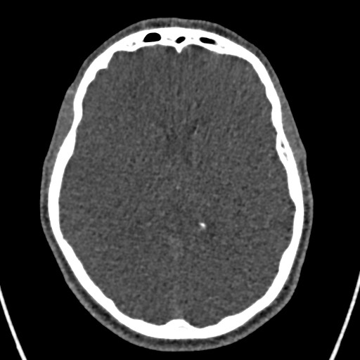 Cerebral arteriovenous malformation (Radiopaedia 78188-90746 Axial non-contrast 98).jpg