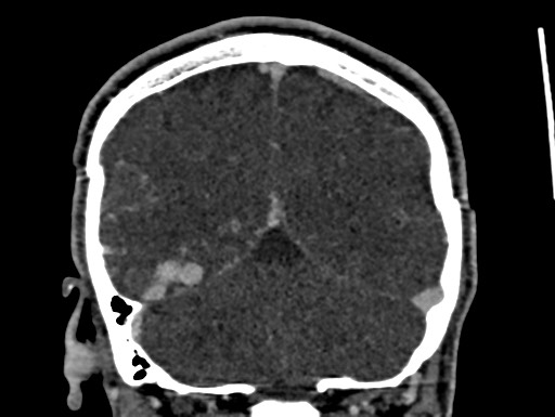 File:Cerebral arteriovenous malformation (Radiopaedia 78188-90746 Coronal C+ delayed 94).jpg