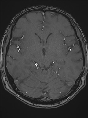 File:Cerebral arteriovenous malformation (Radiopaedia 84015-99245 Axial TOF 114).jpg
