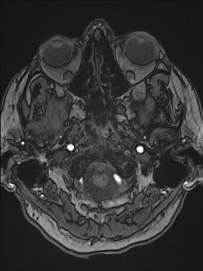 Cerebral arteriovenous malformation (Radiopaedia 84015-99245 Axial TOF 52).jpg