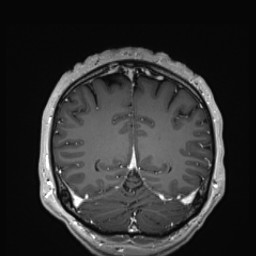 Cerebral arteriovenous malformation (Radiopaedia 84015-99245 Coronal T1 C+ 125).jpg