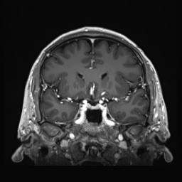Cerebral arteriovenous malformation (Radiopaedia 84015-99245 Coronal T1 C+ 63).jpg