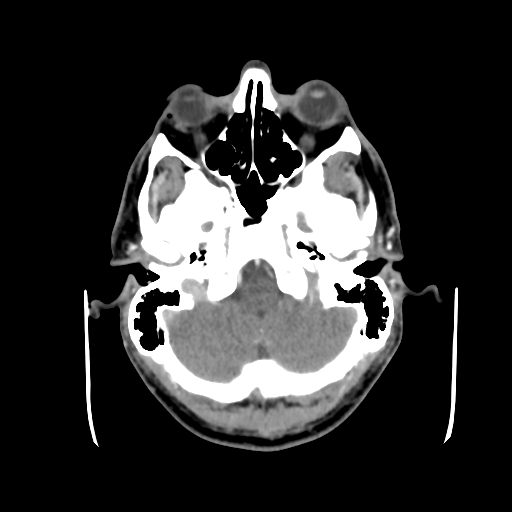 Cerebral arteriovenous malformation (Spetzler-Martin grade 2) (Radiopaedia 41262-44076 Axial C+ 9).png