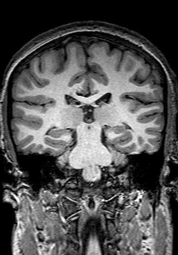 Cerebral arteriovenous malformation at posterior body of corpus callosum (Radiopaedia 74111-84925 Coronal T1 200).jpg