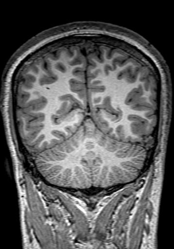 Cerebral arteriovenous malformation at posterior body of corpus callosum (Radiopaedia 74111-84925 Coronal T1 259).jpg