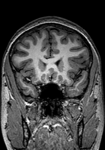 Cerebral arteriovenous malformation at posterior body of corpus callosum (Radiopaedia 74111-84925 Coronal T1 96).jpg