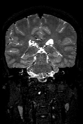 Cerebral arteriovenous malformation at posterior body of corpus callosum (Radiopaedia 74111-84925 Coronal T2 107).jpg