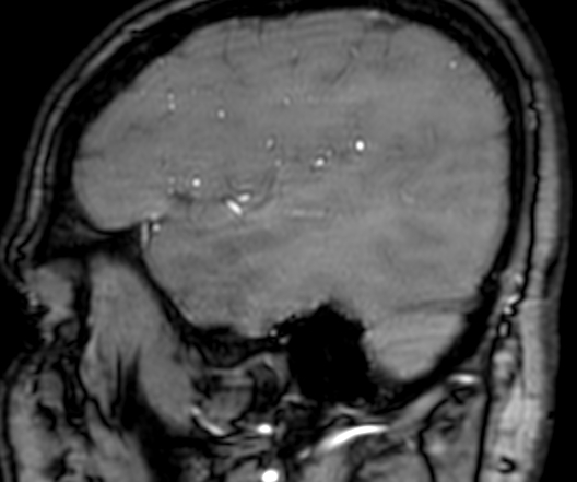 Cerebral arteriovenous malformation at posterior body of corpus callosum (Radiopaedia 74111-84925 J 55).jpg