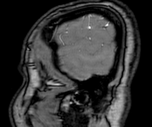 Cerebral arteriovenous malformation at posterior body of corpus callosum (Radiopaedia 74111-84925 J 6).jpg