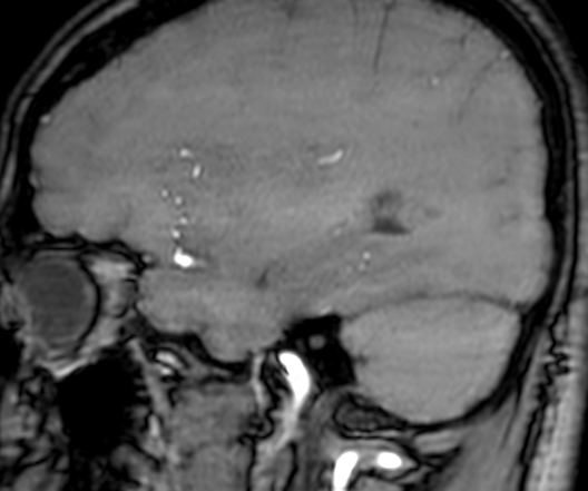 Cerebral arteriovenous malformation at posterior body of corpus callosum (Radiopaedia 74111-84925 J 98).jpg