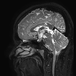 Cerebral arteriovenous malformation at posterior body of corpus callosum (Radiopaedia 74111-84925 Sagittal T2 65).jpg