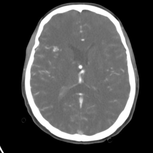 Cerebral arteriovenous malformation with hemorrhage (Radiopaedia 28773-29073 A 26).jpg