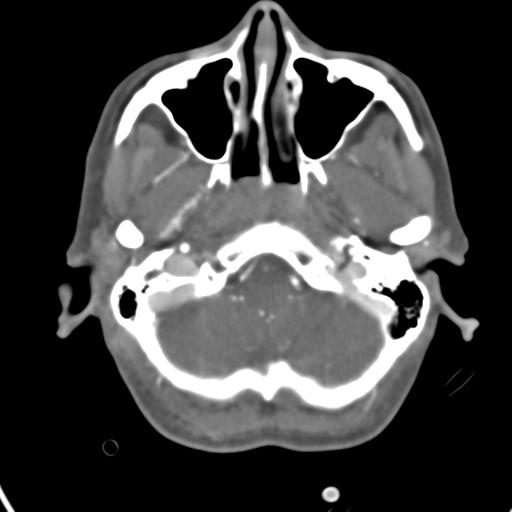 Cerebral arteriovenous malformation with hemorrhage (Radiopaedia 28773-29073 A 46).jpg