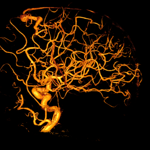 Cerebral arteriovenous malformation with lobar hemorrhage (Radiopaedia 44725-48513 Lateral 39).png