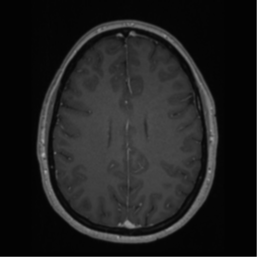 Cerebral cavernoma and development venous anomaly (Radiopaedia 37603-39482 Axial T1 C+ 50).png