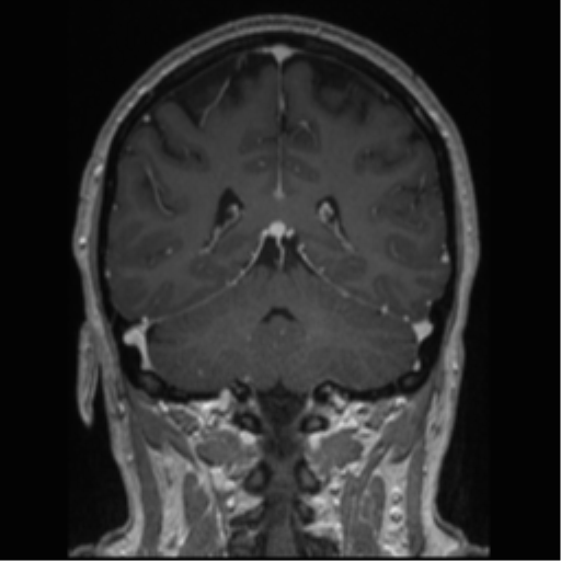 Cerebral cavernoma and development venous anomaly (Radiopaedia 37603-39482 Coronal T1 C+ 35).png