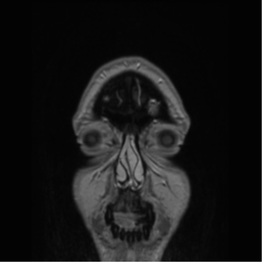 Cerebral cavernoma and development venous anomaly (Radiopaedia 37603-39482 Coronal T1 C+ 89).png
