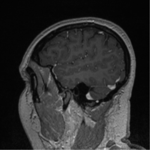 Cerebral cavernoma and development venous anomaly (Radiopaedia 37603-39482 Sagittal T1 C+ 77).png