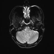 Cerebral cavernous venous malformation (Radiopaedia 70008-80021 Axial DWI 5).jpg