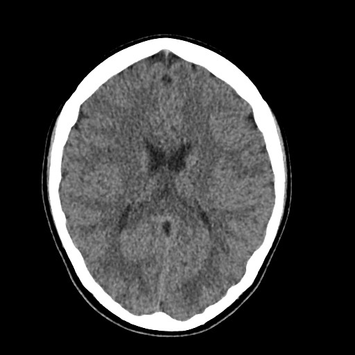 Cerebral cavernous venous malformation (Radiopaedia 70008-80022 Axial non-contrast 30).jpg