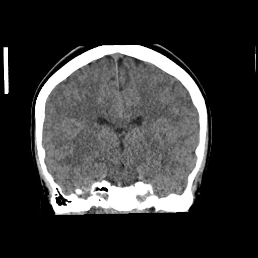 Cerebral cavernous venous malformation (Radiopaedia 70008-80022 non-contrast 39).jpg