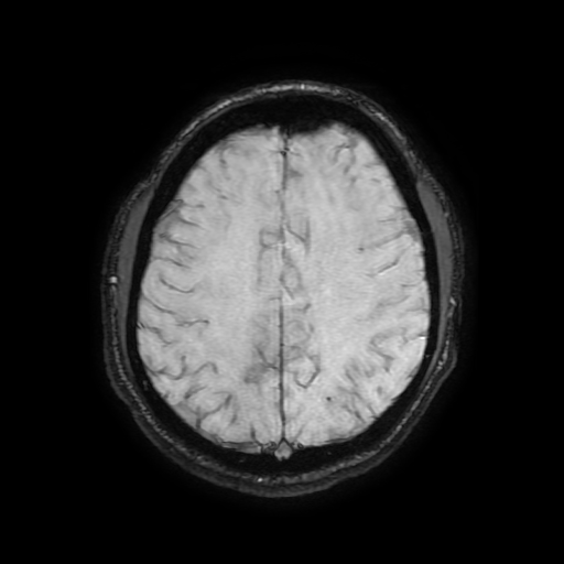Cerebral cavernous venous malformation (Zabramski type II) (Radiopaedia 85511-101198 Axial SWI 87).jpg