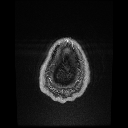 Cerebral cavernous venous malformation (Zabramski type II) (Radiopaedia 85511-101198 Axial T1 C+ fat sat 9).jpg