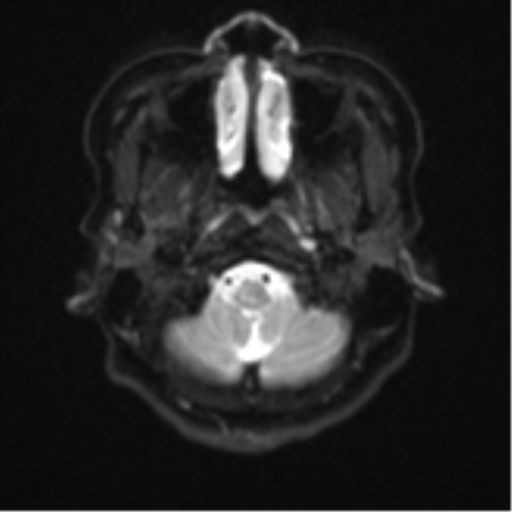 Cerebral cavernous venous malformations (Radiopaedia 48117-52946 Axial DWI 2).png