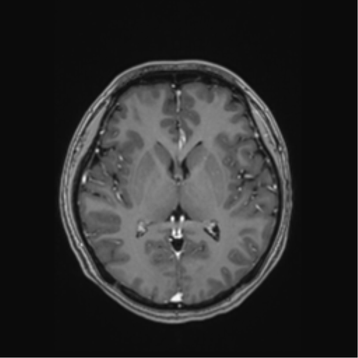 Cerebral cavernous venous malformations (Radiopaedia 48117-52946 Axial T1 C+ 31).png