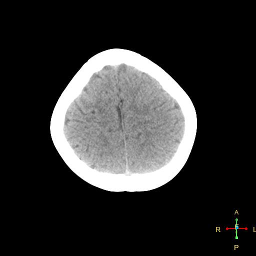 File:Cerebral contusion (Radiopaedia 48869-53911 Axial non-contrast 16).jpg