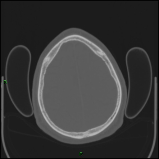 Cerebral contusions (Radiopaedia 33868-35039 Axial bone window 176).jpg